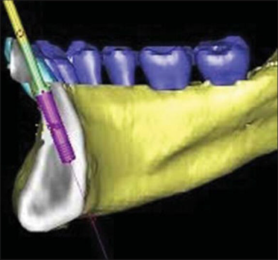 30-year-old female patient with edentulous mandibular anterior region. CBCT shows implant placement site in the mandibular anterior region.